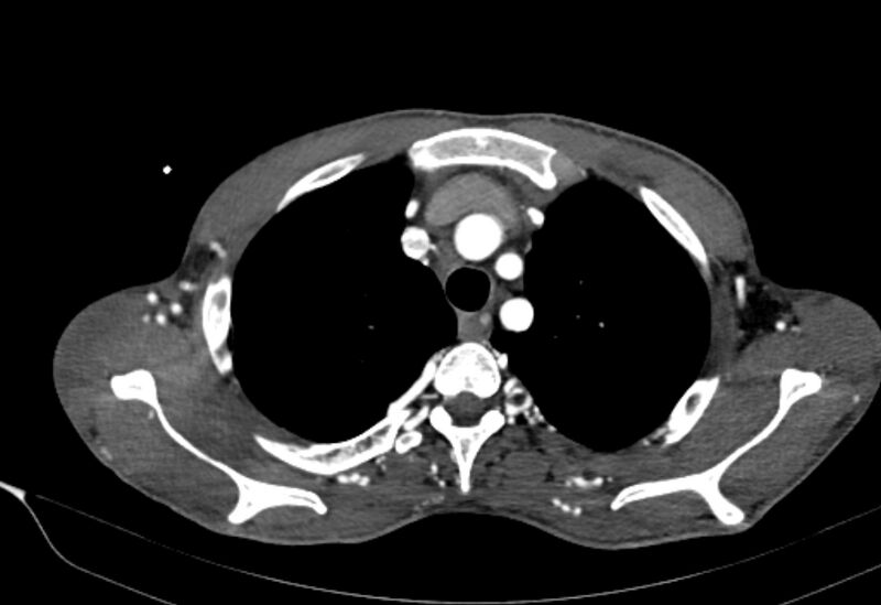File:Coarctation of aorta with aortic valve stenosis (Radiopaedia 70463-80574 A 19).jpg