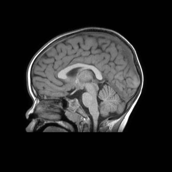 File:Cochlear nerve aplasia - unilateral (Radiopaedia 87910-104413 Sagittal T1 24).jpg