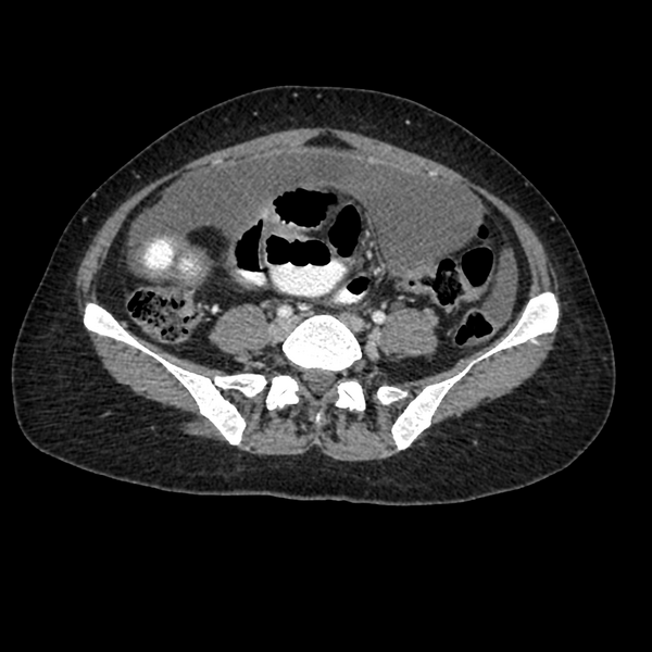 File:Cocoon abdomen with possible tubo-ovarian abscess (Radiopaedia 46235-50636 A 30).png
