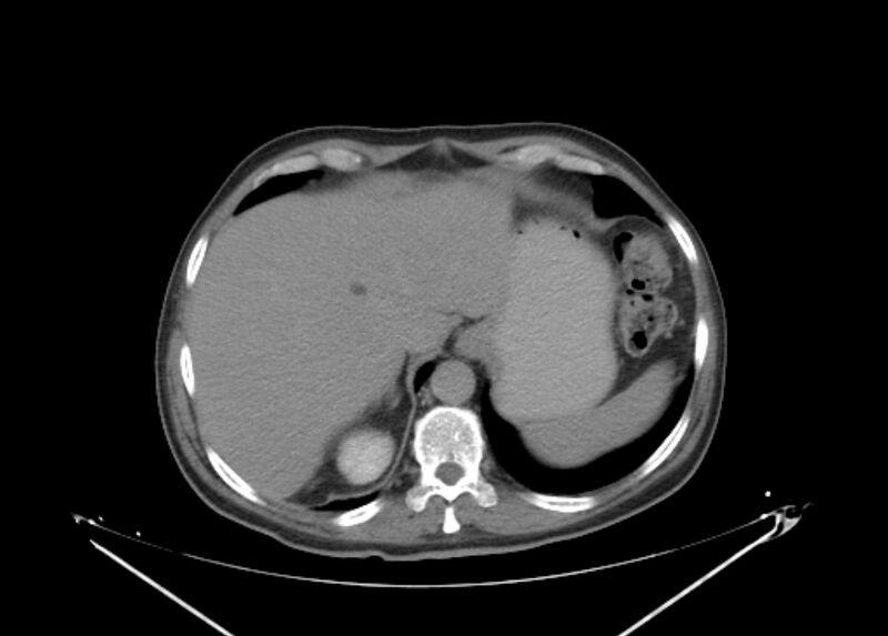 File:Colon cancer mimicking renal cell carcinoma (Radiopaedia 28986-29335 Axial C+ delayed 11).jpg