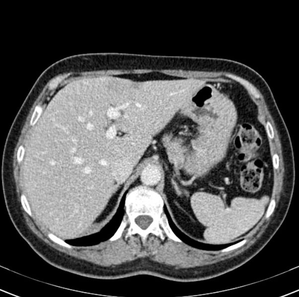 File:Colon carcinoma with hepatic metastases (Radiopaedia 29477-29961 A 26).jpg