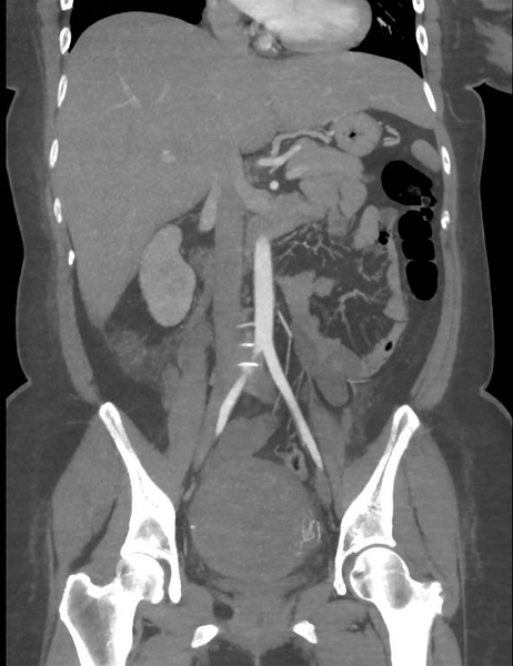 File:Colonic pseudo-obstruction (Radiopaedia 79752-92980 B 35).png