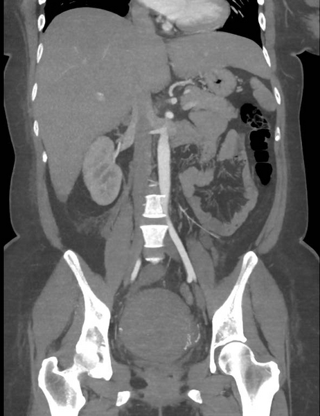 File:Colonic pseudo-obstruction (Radiopaedia 79752-92980 B 36).png