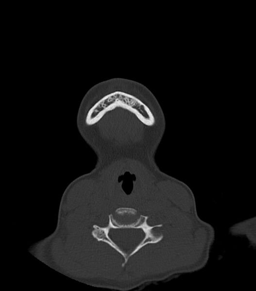 File:Nasoorbitoethmoid fracture (Radiopaedia 90044-107205 Axial bone window 15).jpg