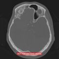 Nasopharyngeal carcinoma recurrence - skull base destruction (Radiopaedia 29107-29490 Axial bone window 66).jpg