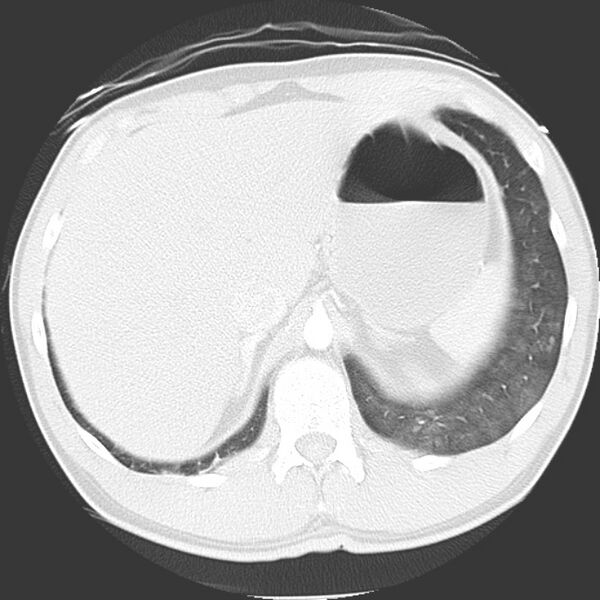 File:Near drowning pulmonary edema (Radiopaedia 16868-16591 Axial lung window 51).jpg