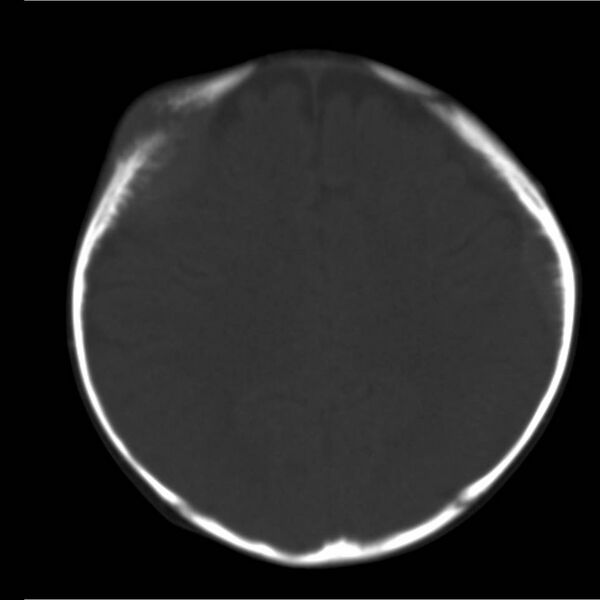 File:Neuroblastoma with skull metastases (Radiopaedia 30326-30958 Axial bone window 15).jpg