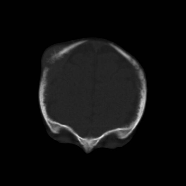 File:Neuroblastoma with skull metastases (Radiopaedia 30326-30958 Coronal bone window 11).jpg