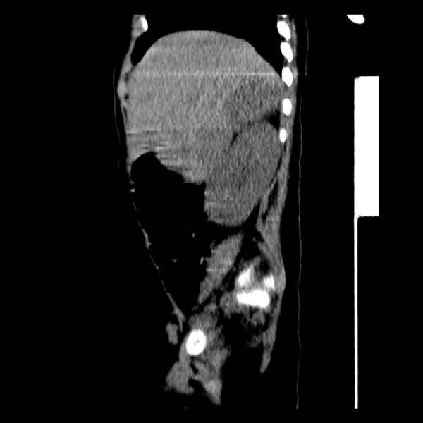 File:Neuroblastoma with skull metastases (Radiopaedia 30326-30960 B 12).jpg