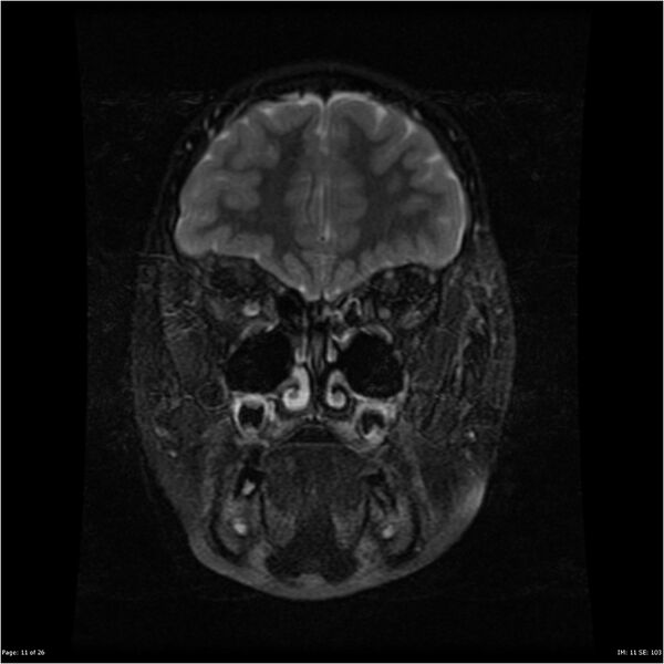 File:Neurofibromatosis type 1 (Radiopaedia 22541-22564 Coronal T2 fat sat 2).jpg
