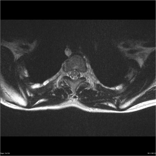 File:Neurofibromatosis type 1 (Radiopaedia 22541-22565 Axial T2 4).jpg