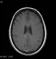 Neurosarcoidosis (Radiopaedia 10930-11351 Axial T1 C+ 13).jpg
