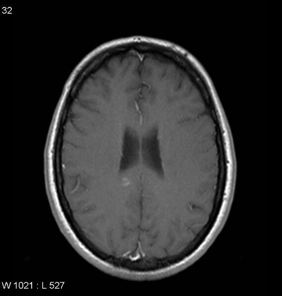File:Neurosarcoidosis (Radiopaedia 10930-11351 Axial T1 C+ 13).jpg