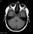 Neurosarcoidosis (Radiopaedia 10930-17204 Axial T1 5).jpg