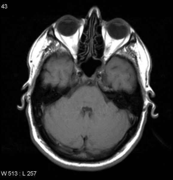 File:Neurosarcoidosis (Radiopaedia 10930-17204 Axial T1 5).jpg