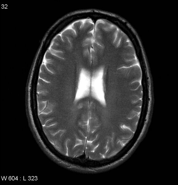 File:Neurosarcoidosis (Radiopaedia 10930-17204 Axial T2 13).jpg