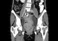 Non-puerperal uterine inversion (Radiopaedia 78343-91094 B 6).jpg