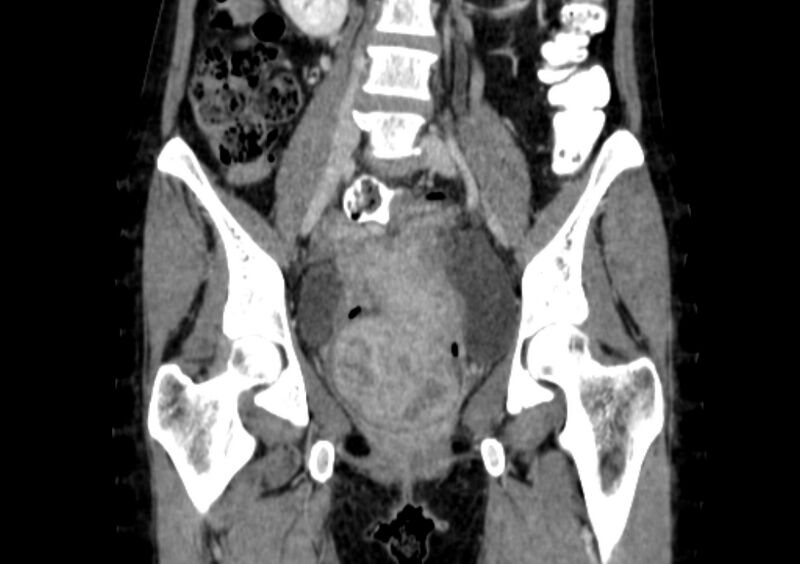 File:Non-puerperal uterine inversion (Radiopaedia 78343-91094 B 6).jpg