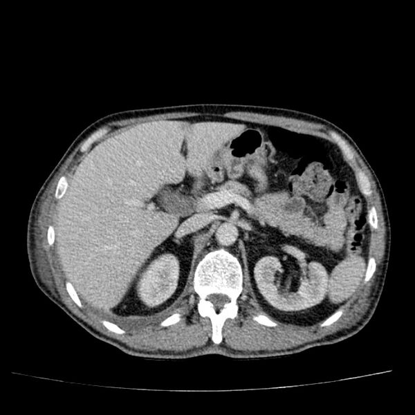 File:Non small-cell lung cancer (Radiopaedia 24467-24769 C+ delayed 64).jpg