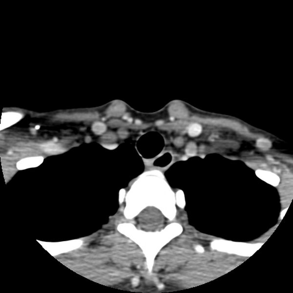 File:Normal CT of the neck (Radiopaedia 14575-14500 Axial C+ 62).jpg