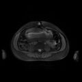 Normal MRI abdomen in pregnancy (Radiopaedia 88001-104541 D 31).jpg