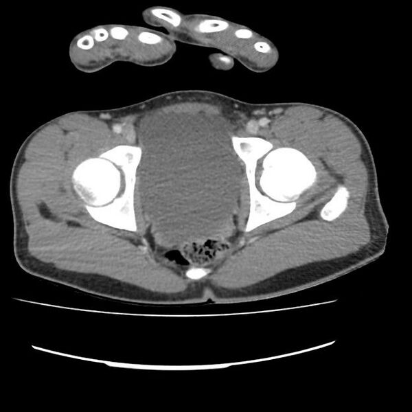 File:Normal dual-phase trauma CT chest,abdomen and pelvis (Radiopaedia 48092-52899 A 109).jpg