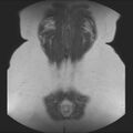 Normal liver MRI with Gadolinium (Radiopaedia 58913-66163 Coronal T2 38).jpg