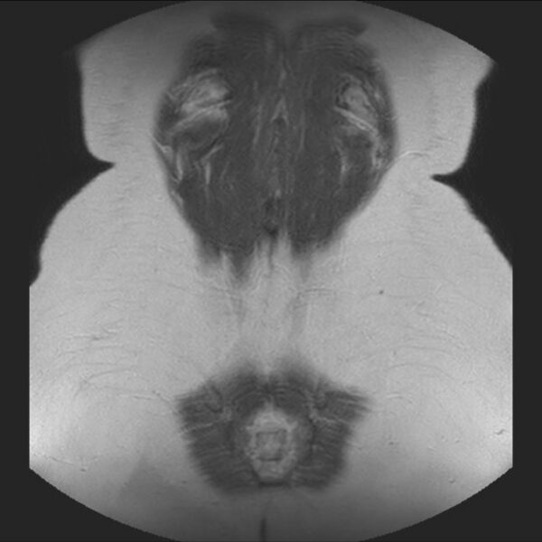 File:Normal liver MRI with Gadolinium (Radiopaedia 58913-66163 Coronal T2 38).jpg