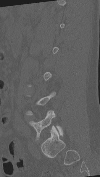 File:Normal lumbar spine CT (Radiopaedia 46533-50986 Sagittal bone window 35).png