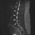 Normal lumbar spine MRI (Radiopaedia 47857-52609 Sagittal STIR 13).jpg