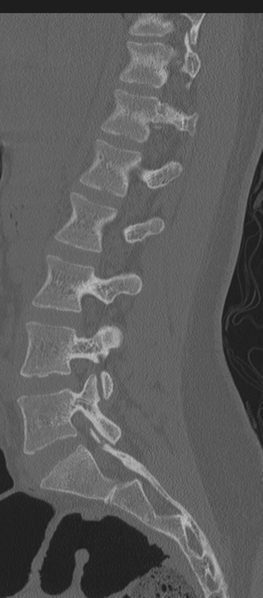 File:Normal lumbosacral CT (Radiopaedia 37923-39867 Sagittal bone window 60).png