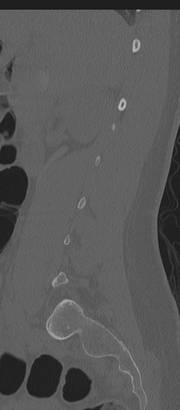 File:Normal lumbosacral CT (Radiopaedia 37923-39867 Sagittal bone window 71).png