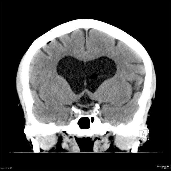File:Normal pressure hydrocephalus (Radiopaedia 24415-24736 Coronal non-contrast 11).jpg
