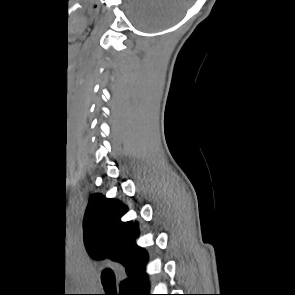 File:Normal trauma spine imaging (age 16) (Radiopaedia 45335-49358 C 7).jpg