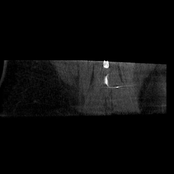 File:Oblique sublaminar lumbar puncture (Radiopaedia 90103-107350 Coronal non-contrast 11).jpeg