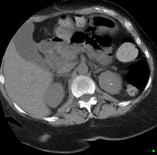 File:Obstructed infected horseshoe kidney (Radiopaedia 18116-17898 non-contrast 2).jpg
