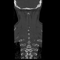Occipital condyle fracture (Radiopaedia 31755-32691 Coronal bone window 31).jpg