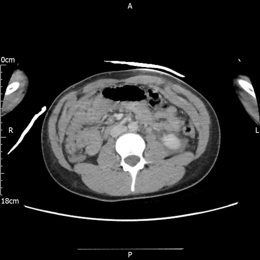 AAST grade IV kidney injury with CEUS follow-up (Radiopaedia 72353-82877 Axial C+ portal venous phase 35).jpg