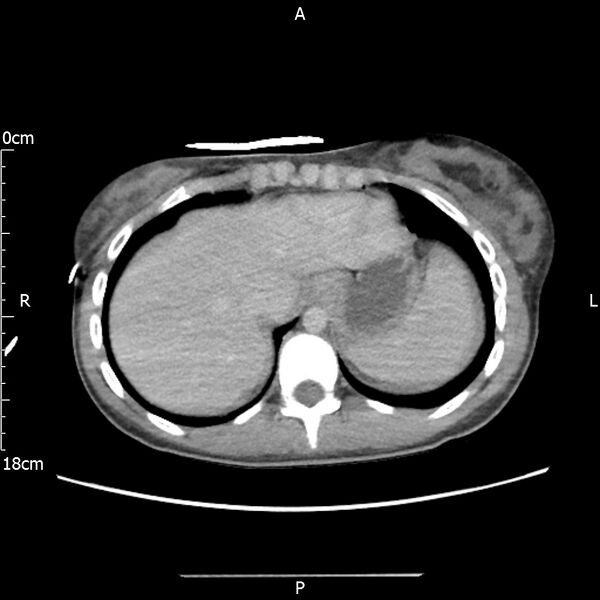 File:AAST grade IV kidney injury with CEUS follow-up (Radiopaedia 72353-82877 Axial C+ portal venous phase 8).jpg