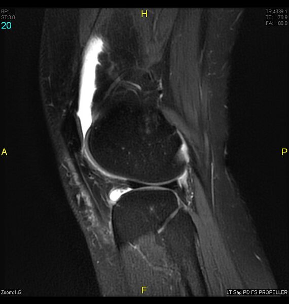 File:ACL mucoid degeration with cystic changes (Radiopaedia 48428-53341 Sagittal PD fat sat 18).jpg