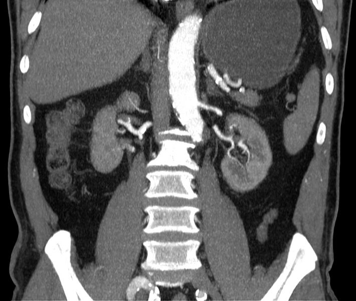 File:Abdominal aortic aneurysm (Radiopaedia 22421-22458 C 26).jpg