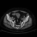 Abdominal aortic aneurysm (Radiopaedia 25855-26001 Axial C+ arterial phase 111).jpg