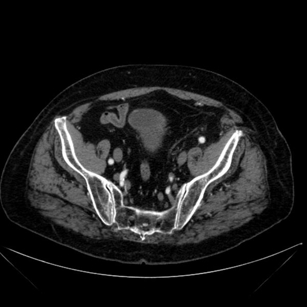 File:Abdominal aortic aneurysm (Radiopaedia 25855-26001 Axial C+ arterial phase 111).jpg