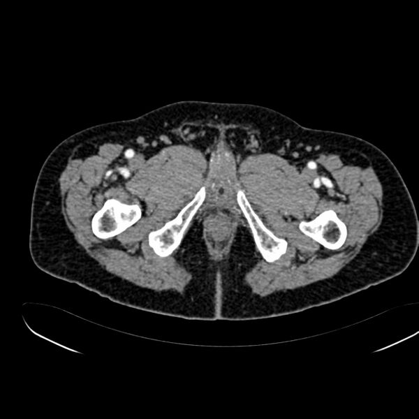 File:Abdominal aortic aneurysm (Radiopaedia 75131-86203 Axial C+ arterial phase 51).jpg