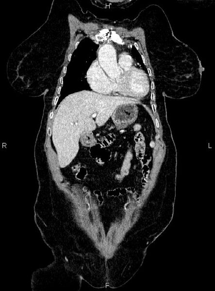File:Abdominal aortic aneurysm (Radiopaedia 85063-100606 Coronal C+ arterial phase 10).jpg