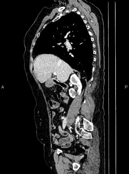 File:Abdominal aortic aneurysm (Radiopaedia 85063-100606 Sagittal C+ arterial phase 27).jpg