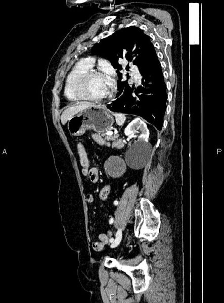 File:Abdominal aortic aneurysm (Radiopaedia 85063-100606 Sagittal C+ arterial phase 57).jpg