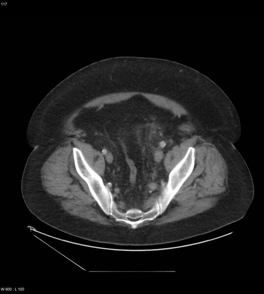 File:Abdominal aortic aneurysm with intramural hematoma then rupture (Radiopaedia 50278-55631 Axial C+ arterial phase 108).jpg