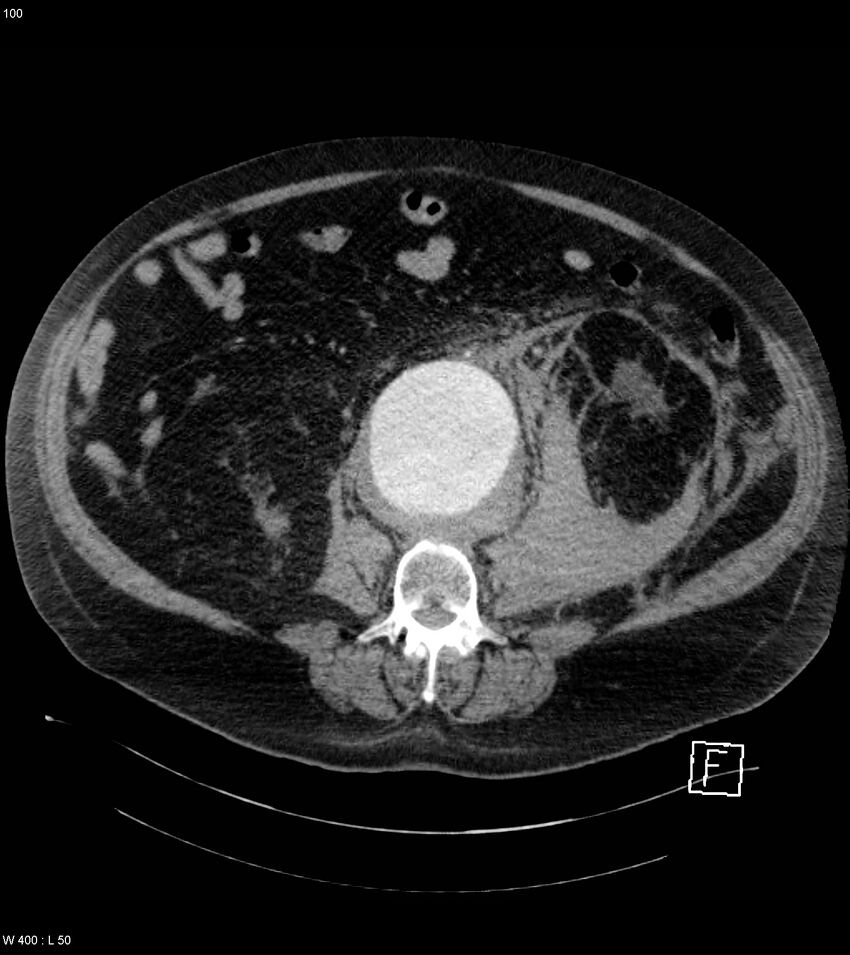 Abdominal aortic aneurysm with intramural hematoma then rupture (Radiopaedia 50278-55632 Axial C+ arterial phase 99).jpg