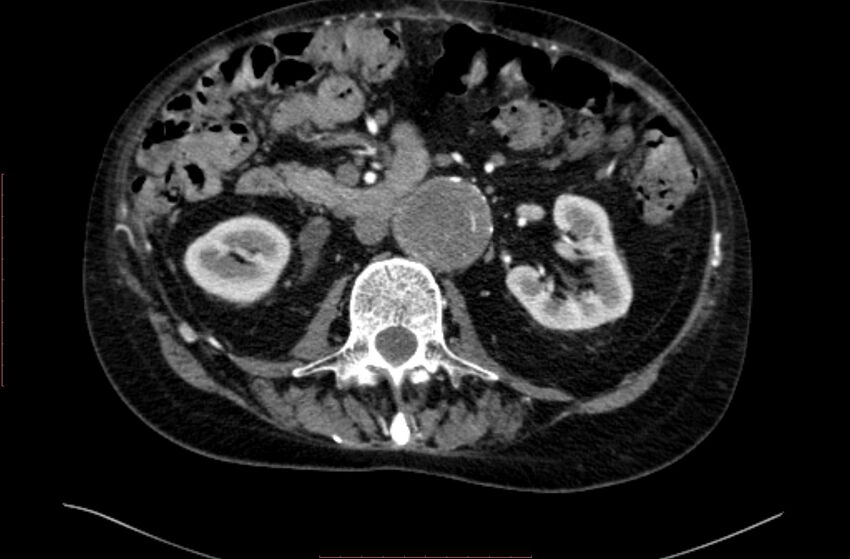 Abdominal aortic interposition tube graft and aneurysm thrombosis (Radiopaedia 71438-81857 Axial C+ arterial phase 67).jpg
